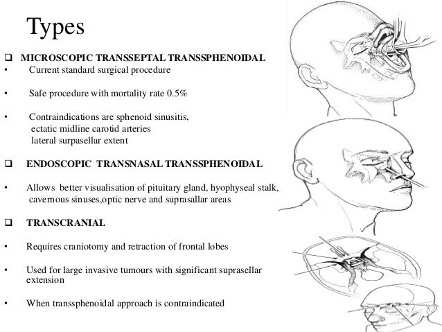 pituitary gland tumor survival rate pituitary gland tumor survival rate